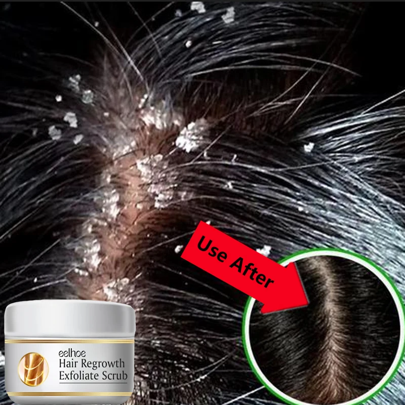 Fast Anti Dandruff Hair Treatm - Scalp Scrub Exfoliant recension och pris