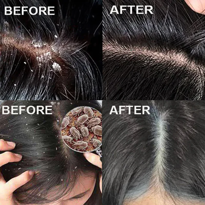 Fast Anti Dandruff Hair Treatm - Scalp Scrub Exfoliant recension och pris